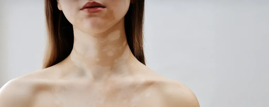 Causes of Vitiligo: Reveal the Factors of Skin Depigmentation