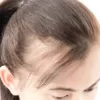 Hair Loss