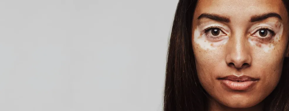 Vitiligo Causes