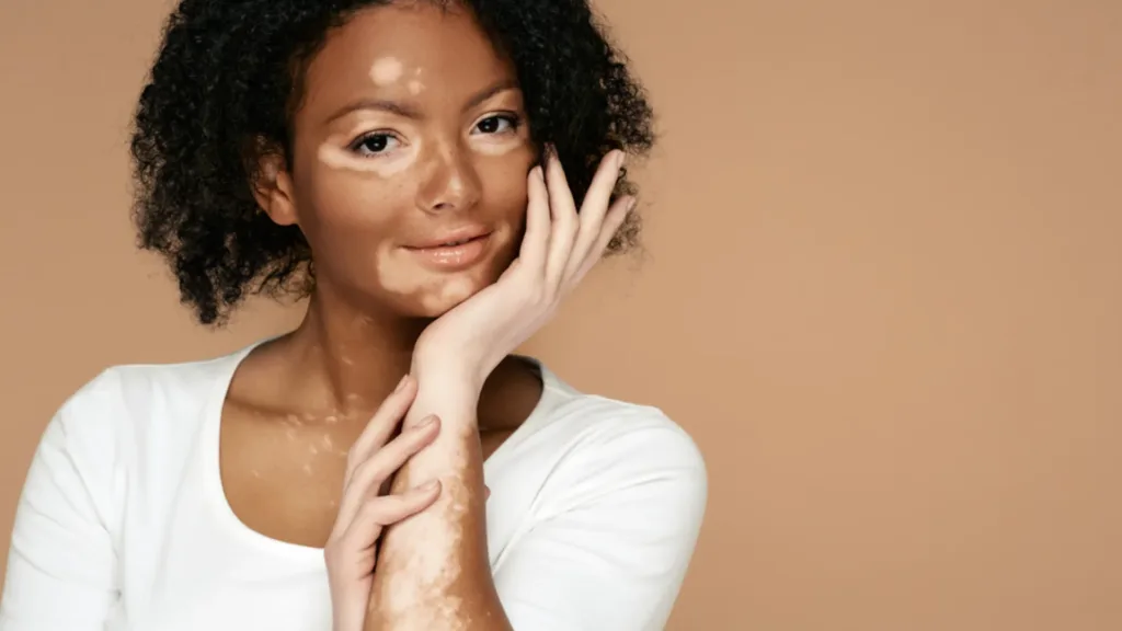 Is Vitiligo a Disability