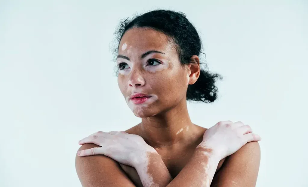 Is Vitiligo a Disability