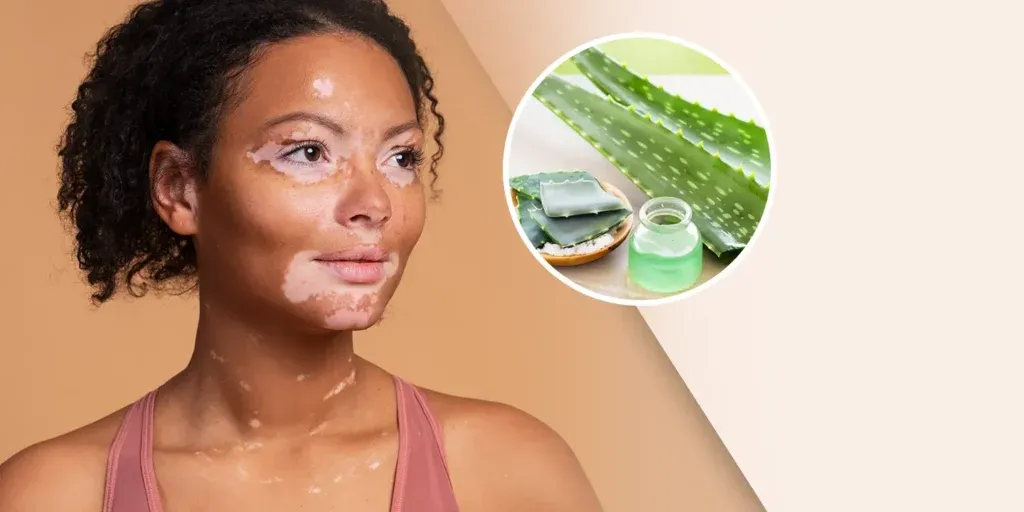 Struggle of Vitiligo