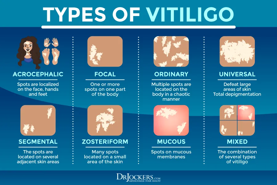 Types of Vitiligo