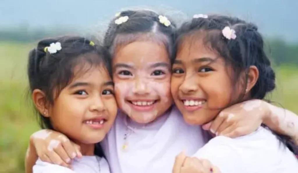 Vitiligo in Children