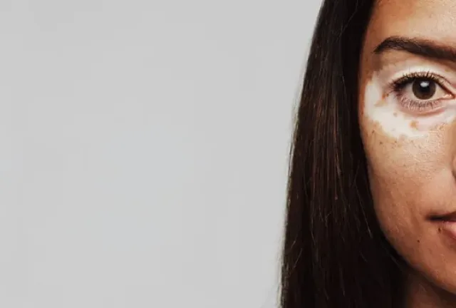 Vitiligo Causes