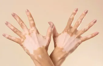 Is Vitiligo Contagious