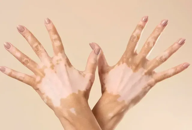 Is Vitiligo Contagious