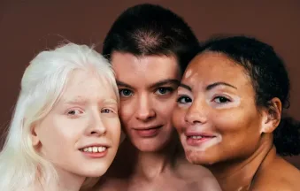 white people get vitiligo