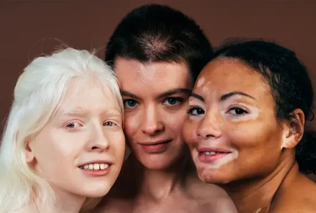 white people get vitiligo